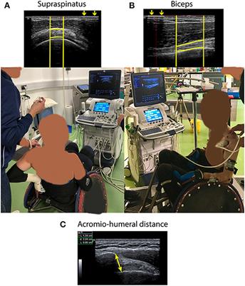 Shoulder Tendon Adaptations Following a Graded Exercise Test to Exhaustion in Highly Trained Wheelchair Rugby Athletes With Different Impairments